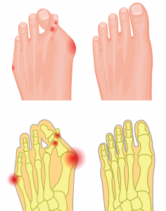 בהונות חופפות  | Overlapping toes
