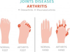 דלקת פרקים שיגרונית |  Rheumatoid Arthritis