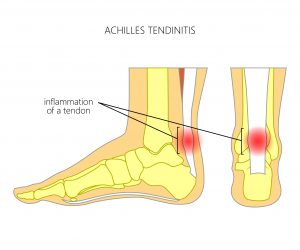 דלקת בגיד האכילס  | Achilles tendonitis