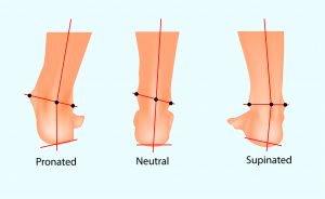 פלטפוס |  Overpronation