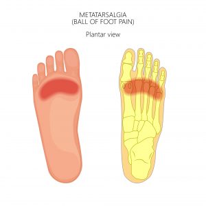 כאב בעצמות המסרק  | Metatarsalgia