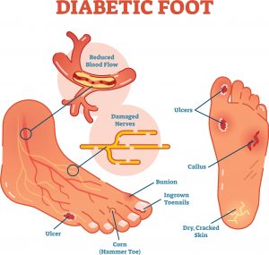 נוירופתיה | Diabetic Neuropathy