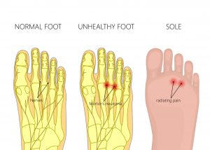 נוירומה ע"ש מורטון  | Morton’s Neuroma