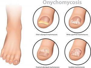 פטרת  |   ONYCHOMYCOSIS & TINEA PEDIS
