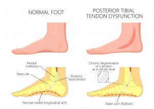 דלקת בגיד  |  Posterior Tibial Tendonitis