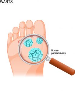 יבלת ויראלית  | Plantar wart
