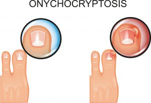 ציפורן חודרנית Ingrowing Toenail