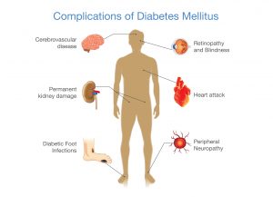 כף רגל סוכרתית | Diabetic Foot