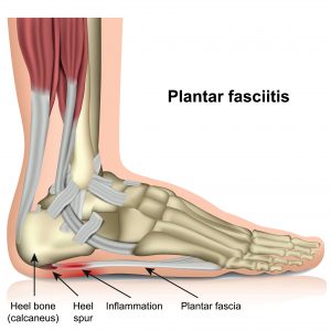 דלקת ברצועות כף הרגל | Plantar Fasciitis