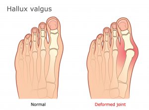 הלוקס ואלגוס |  Hallux valgus/Bunions