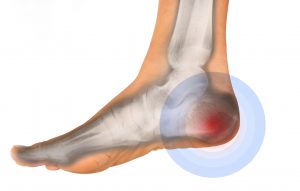 כאב בעקב  |  Heel pain